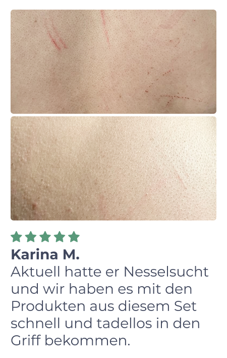 Zwei Fotos aus der Nähe zeigen gereizte Haut mit roten Flecken und Kratzern. In der folgenden 5-Sterne-Bewertung von Karina M. heißt es, dass ein Produktset ihre Nesselsucht schnell und effektiv behandelt hat. Der Text ist auf Deutsch.