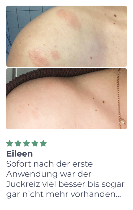 Zwei Fotos einer Schulter: Das obere Bild zeigt rote, gereizte Stellen auf der Haut; das untere Bild zeigt denselben Bereich mit klarer, gesunder Haut. Unter den Fotos ist ein Text in deutscher Sprache zu sehen.