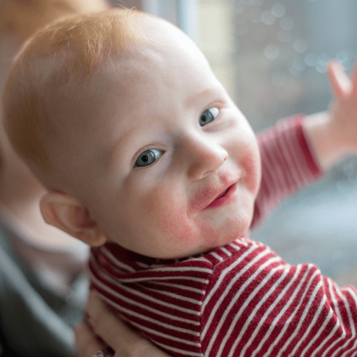 Neurodermitis bei Babys und Kindern