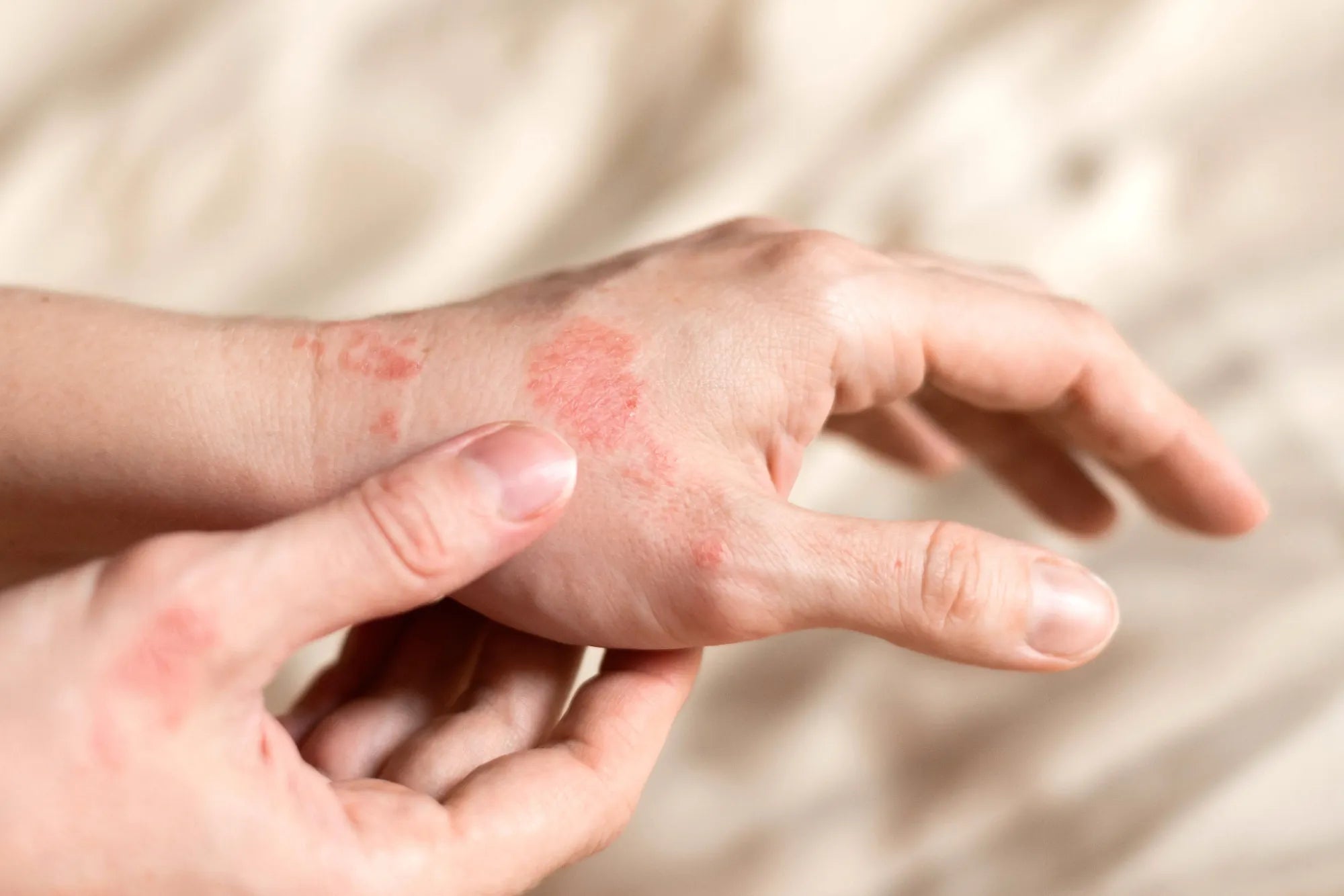 Ekzeme: Der große Ratgeber zu Ursachen, Symptomen & moderner Behandlung