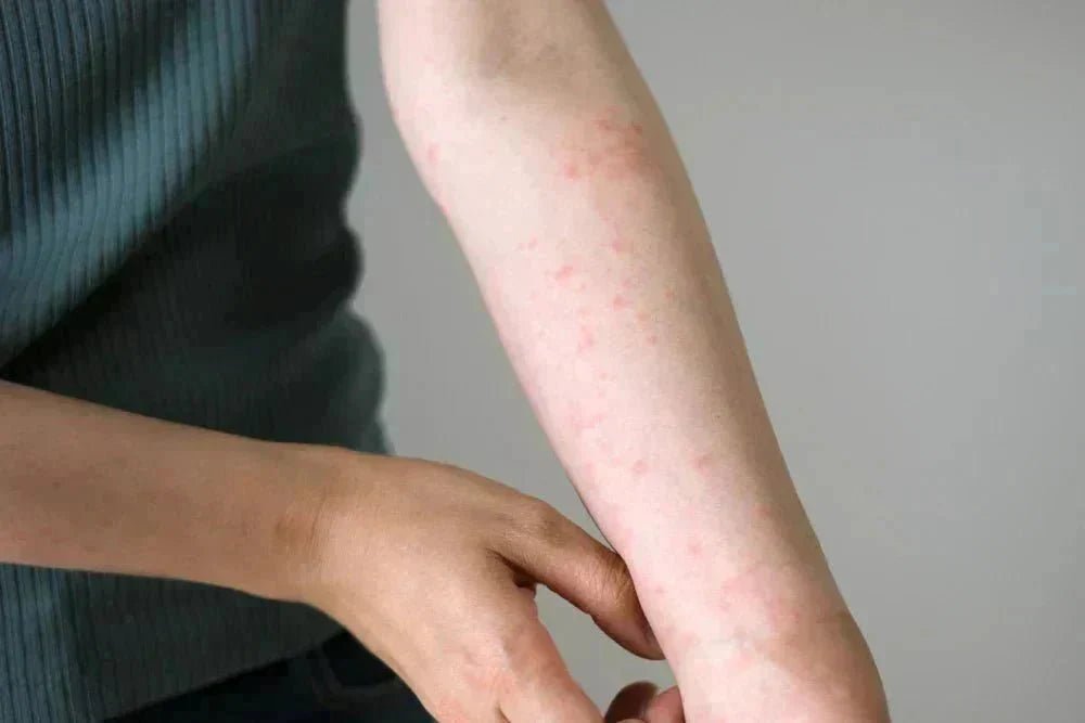 Unterarm mit roten, juckenden Hautausschlägen, Person kratzt sich