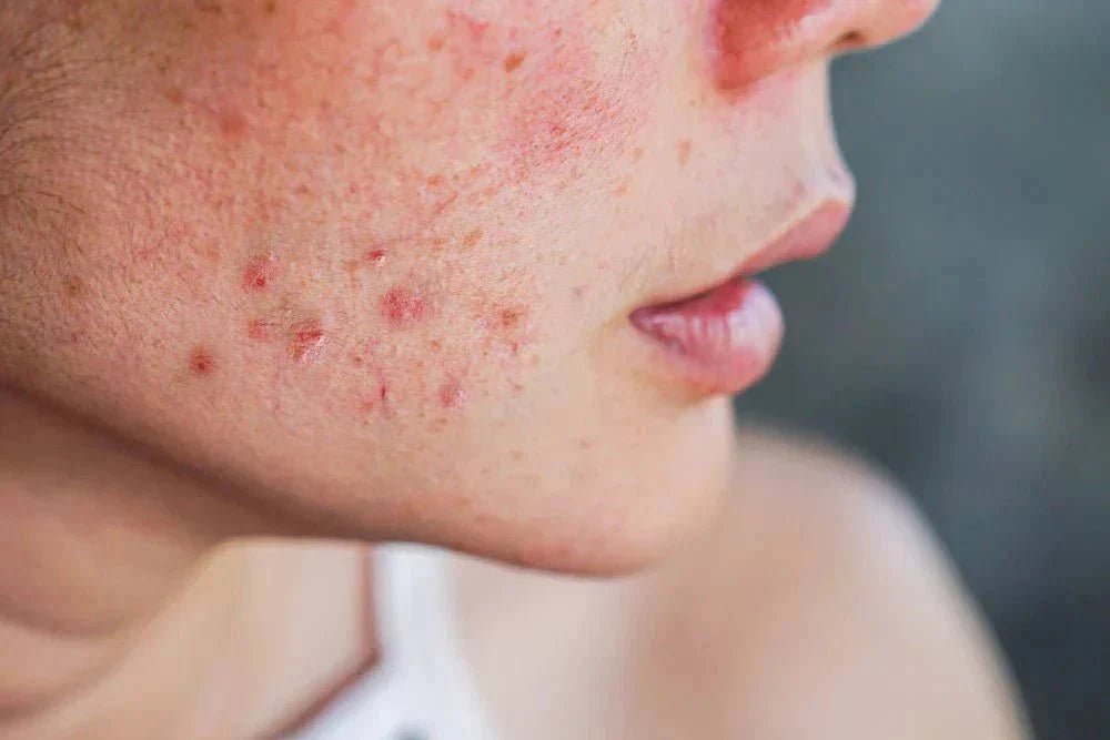 Nahaufnahme eines roten Hautausschlags mit kleinen Pusteln auf der Wange einer Person