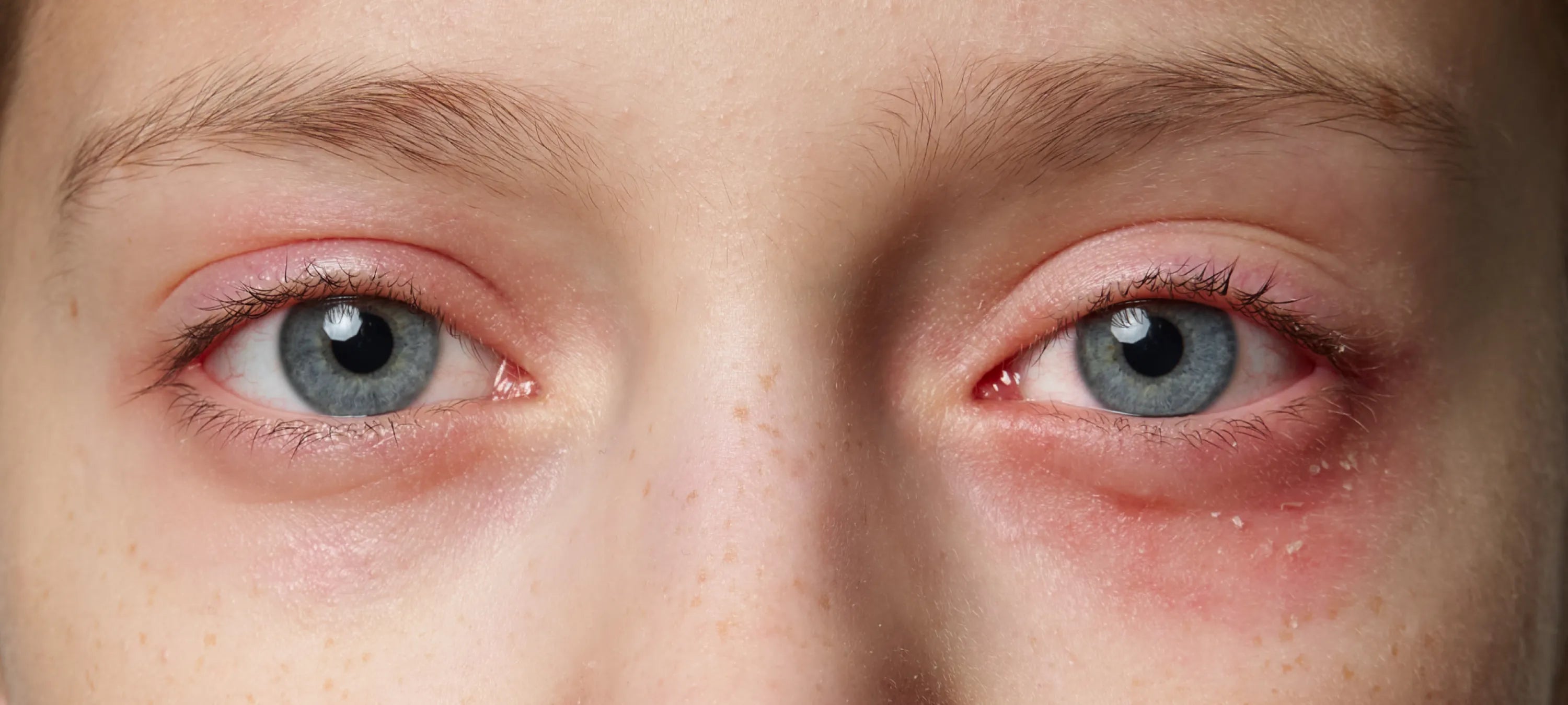 Nahaufnahme von Augen mit geröteter, gereizter Haut um den Augenbereich