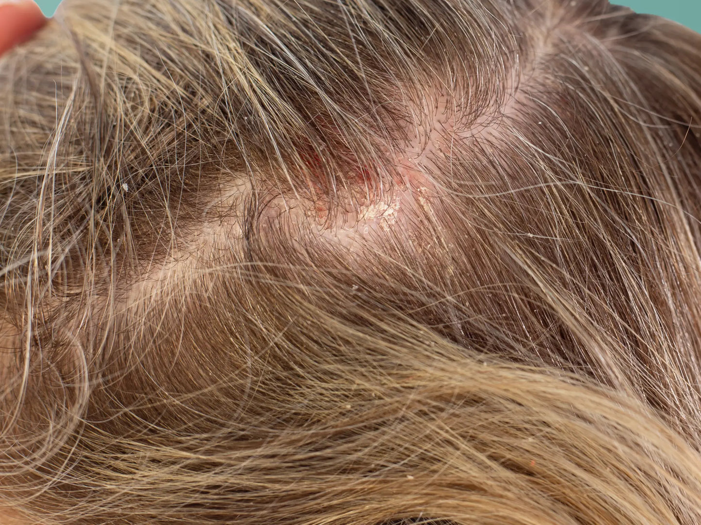 Psoriasis_Kopfhaut