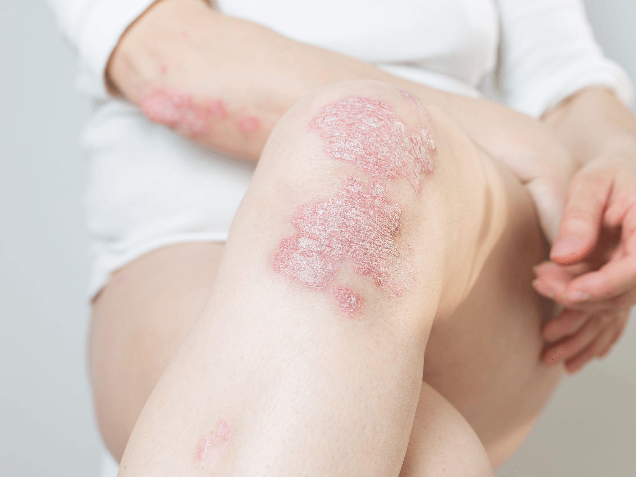 Knie_psoriasis