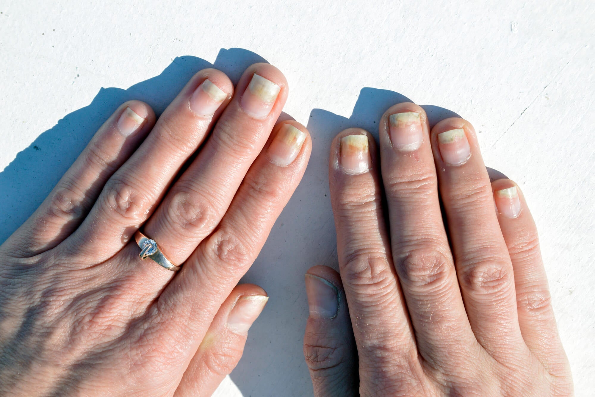 Nagelpsoriasis