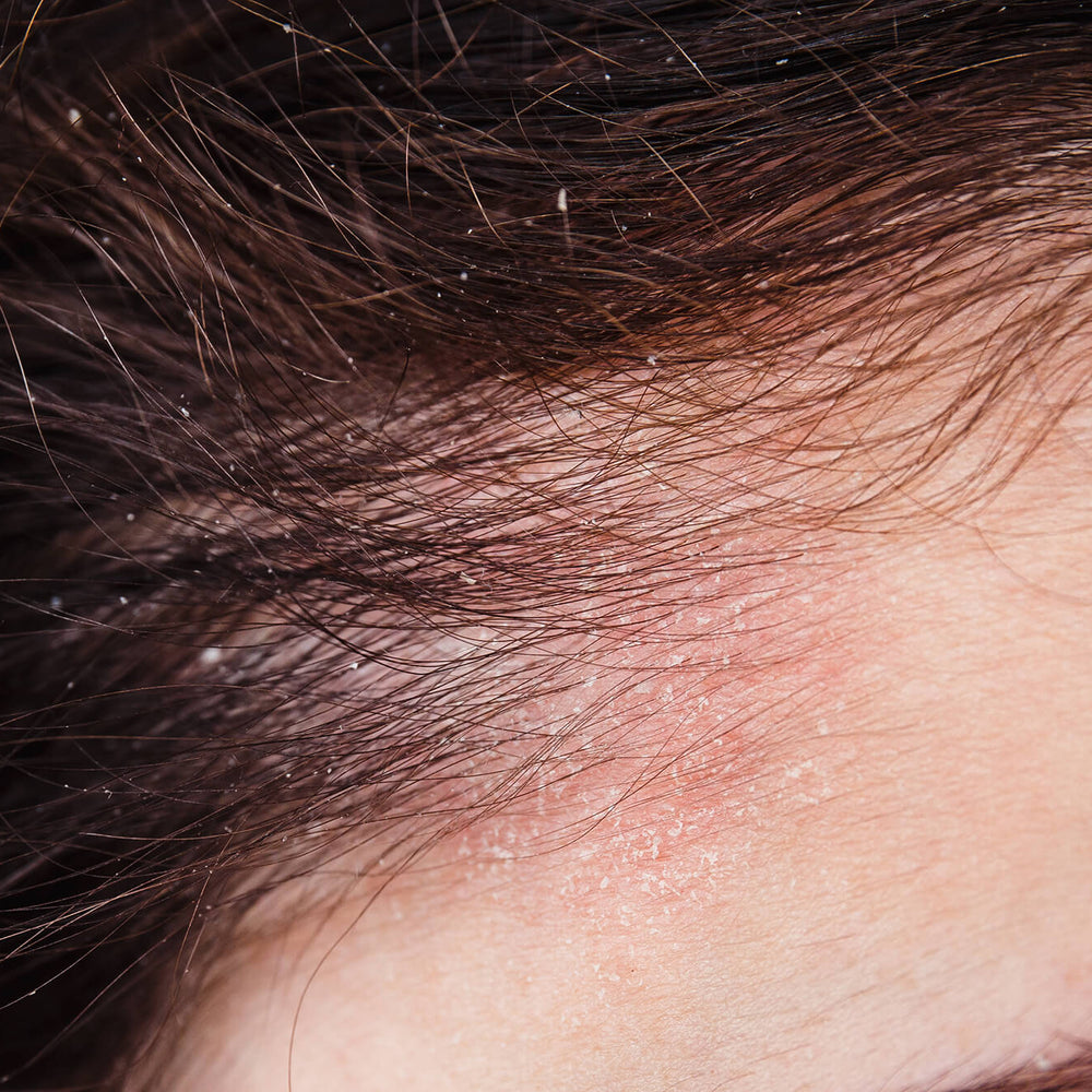 Kopfhaut_Psoriasis