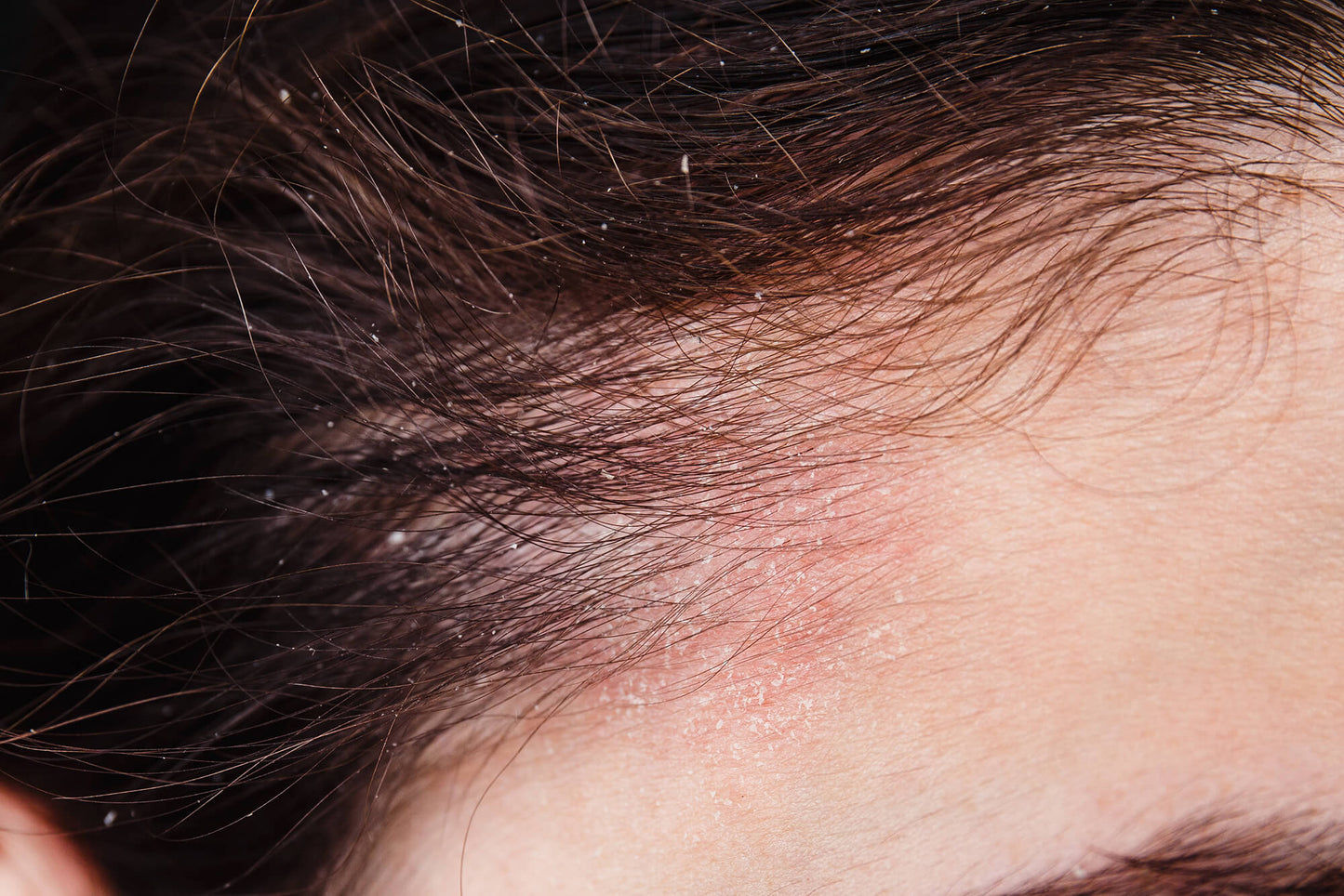Kopfhaut_Psoriasis