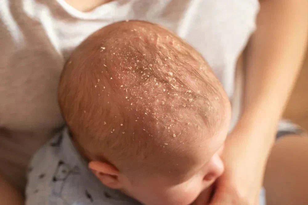 Kleines Baby mit schuppiger Kopfhaut, gehalten von einer Person im Hintergrund