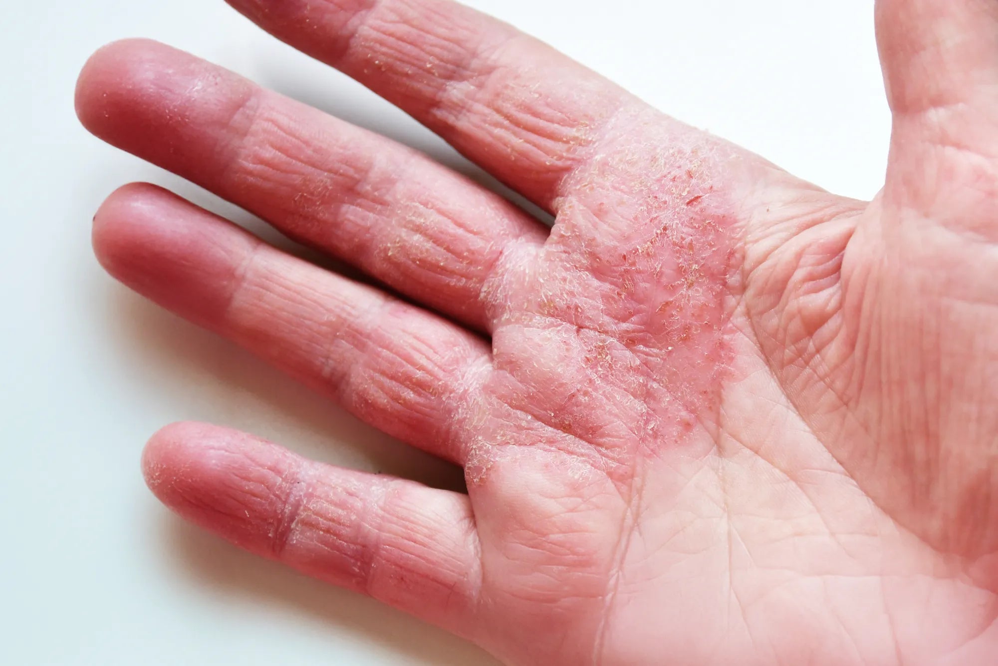 Neurodermitis: Der große Ratgeber zu Ursachen, Symptomen & moderner Behandlung