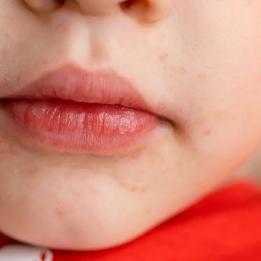 Kindergesicht mit perioraler Dermatitis, Hautausschlag um Mund und Kinn sichtbar