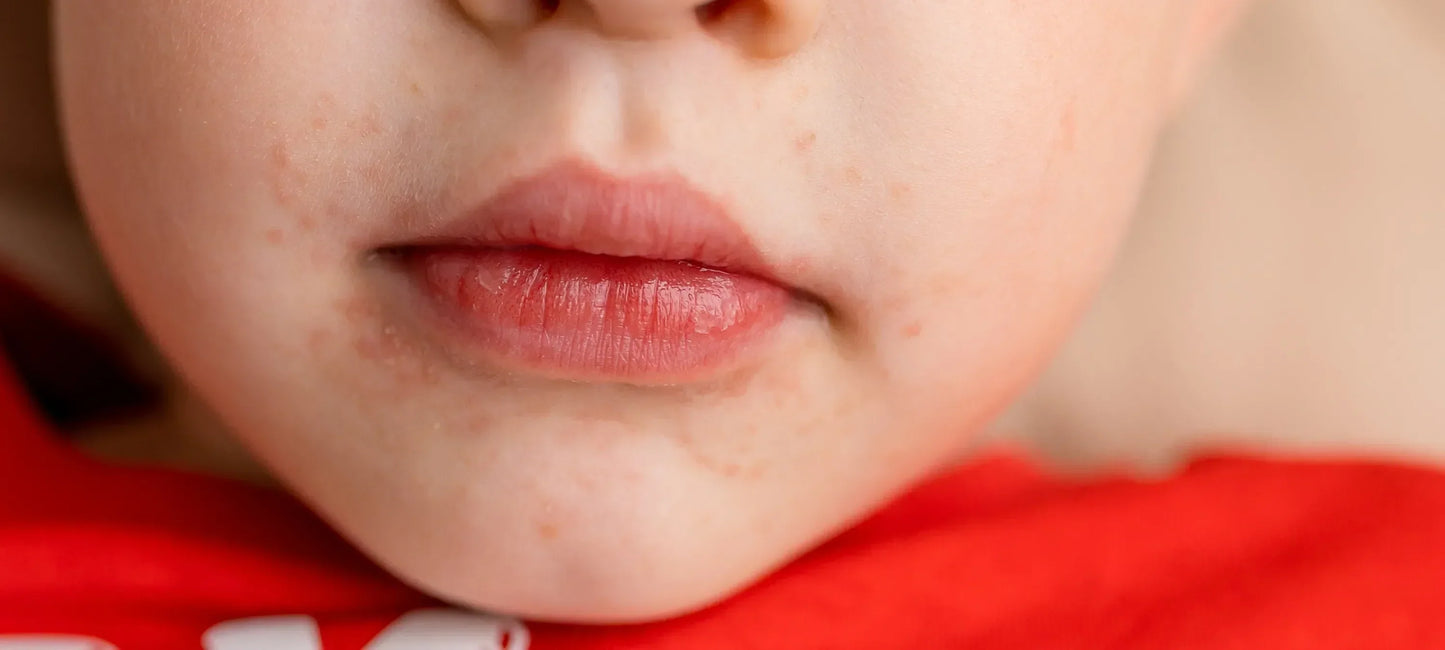 Kindergesicht mit perioraler Dermatitis, Hautausschlag um Mund und Kinn sichtbar