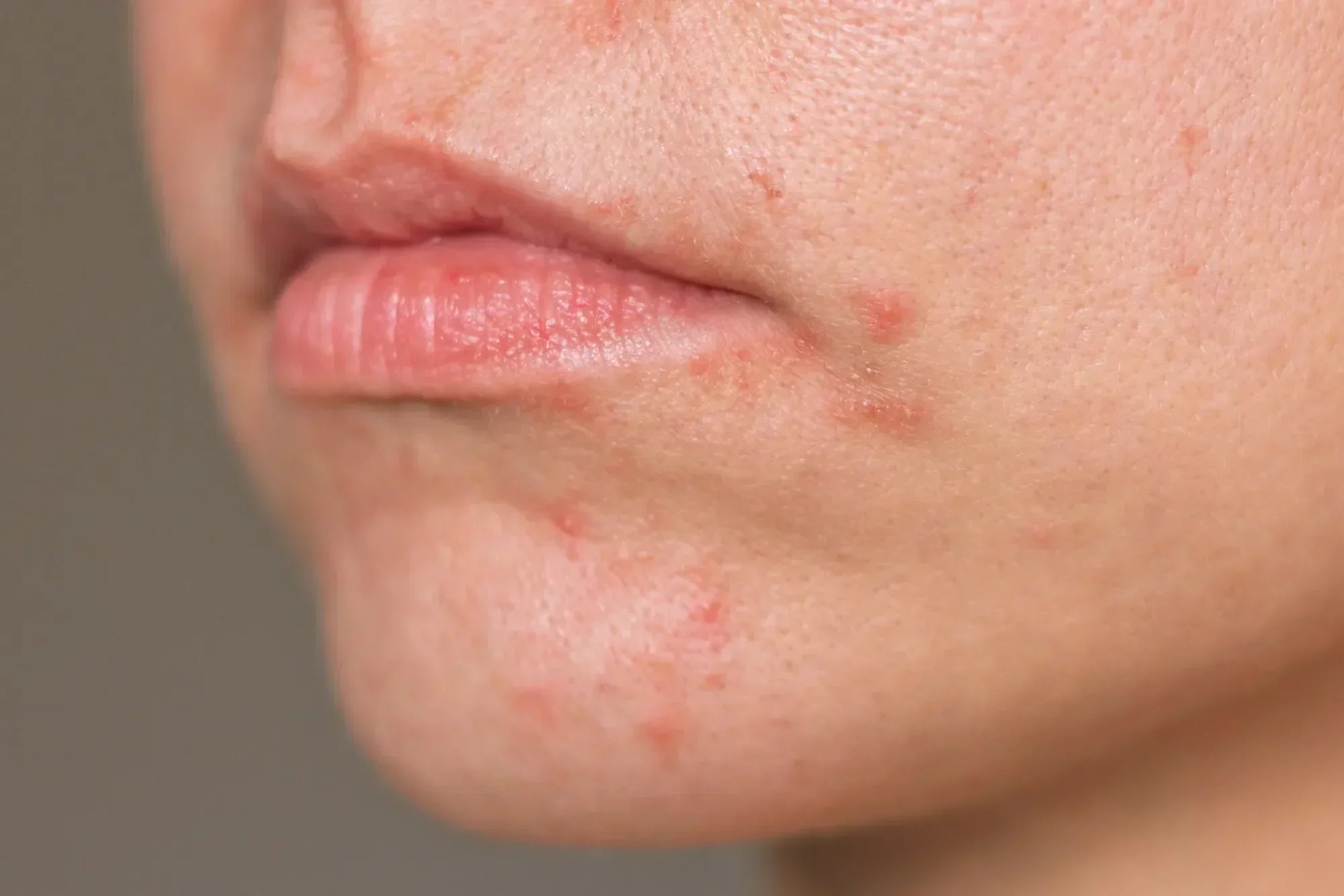 Nahaufnahme eines Gesichts mit perioraler Dermatitis um Mund und Kinn, sichtbare Rötungen und Hautunreinheiten