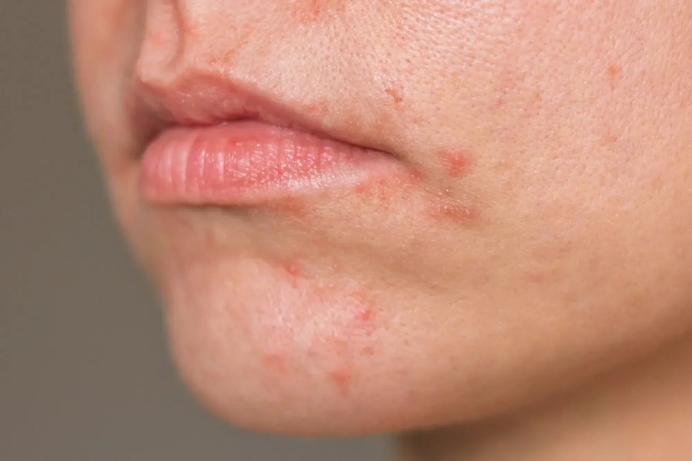 Nahaufnahme eines Gesichts mit perioraler Dermatitis um Mund und Kinn, sichtbare Rötungen und Hautunreinheiten