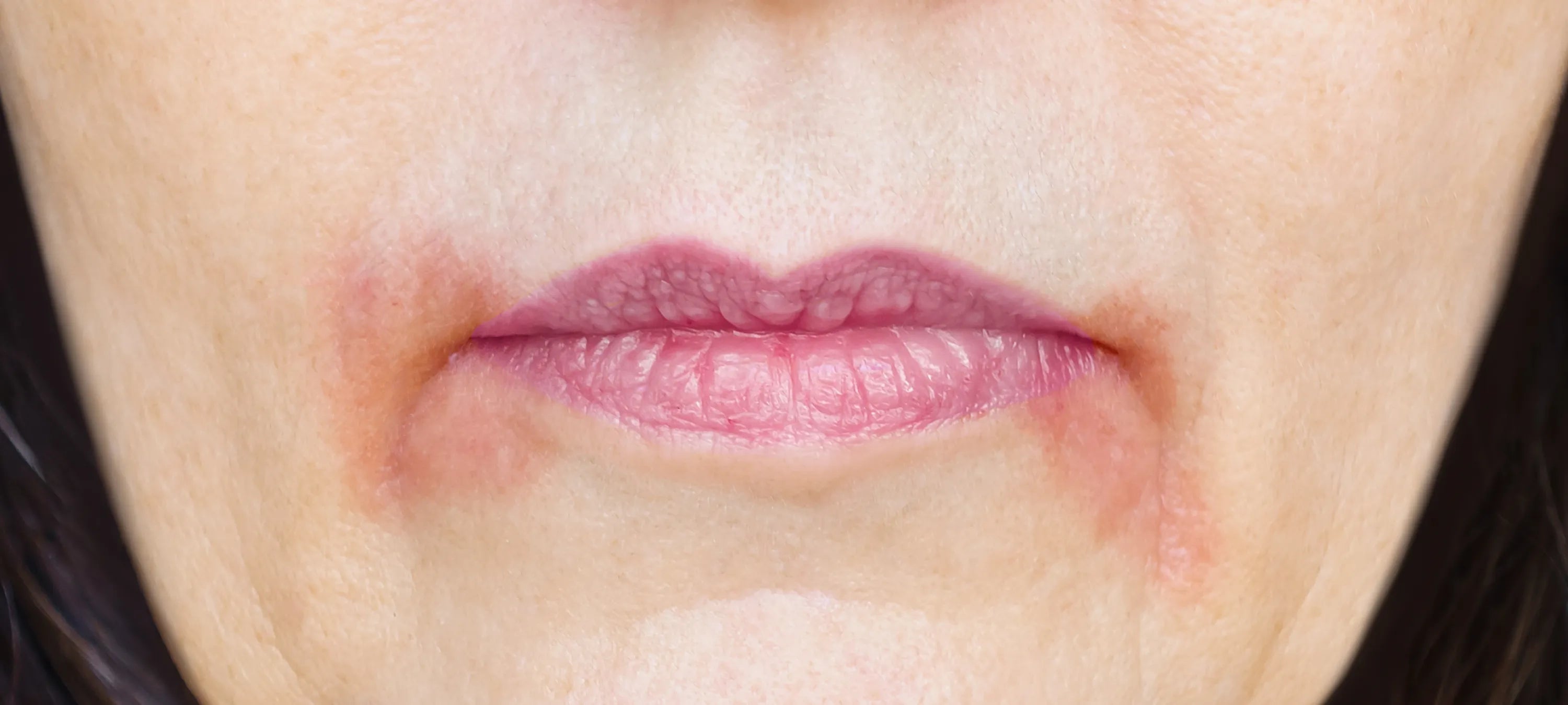 Nahaufnahme eines Mundbereichs mit perioraler Dermatitis, sichtbare Rötung und Hautirritation um die Lippen