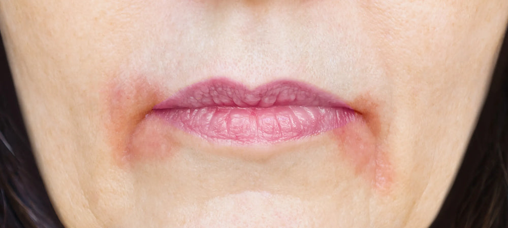 Nahaufnahme eines Mundbereichs mit perioraler Dermatitis, sichtbare Rötung und Hautirritation um die Lippen