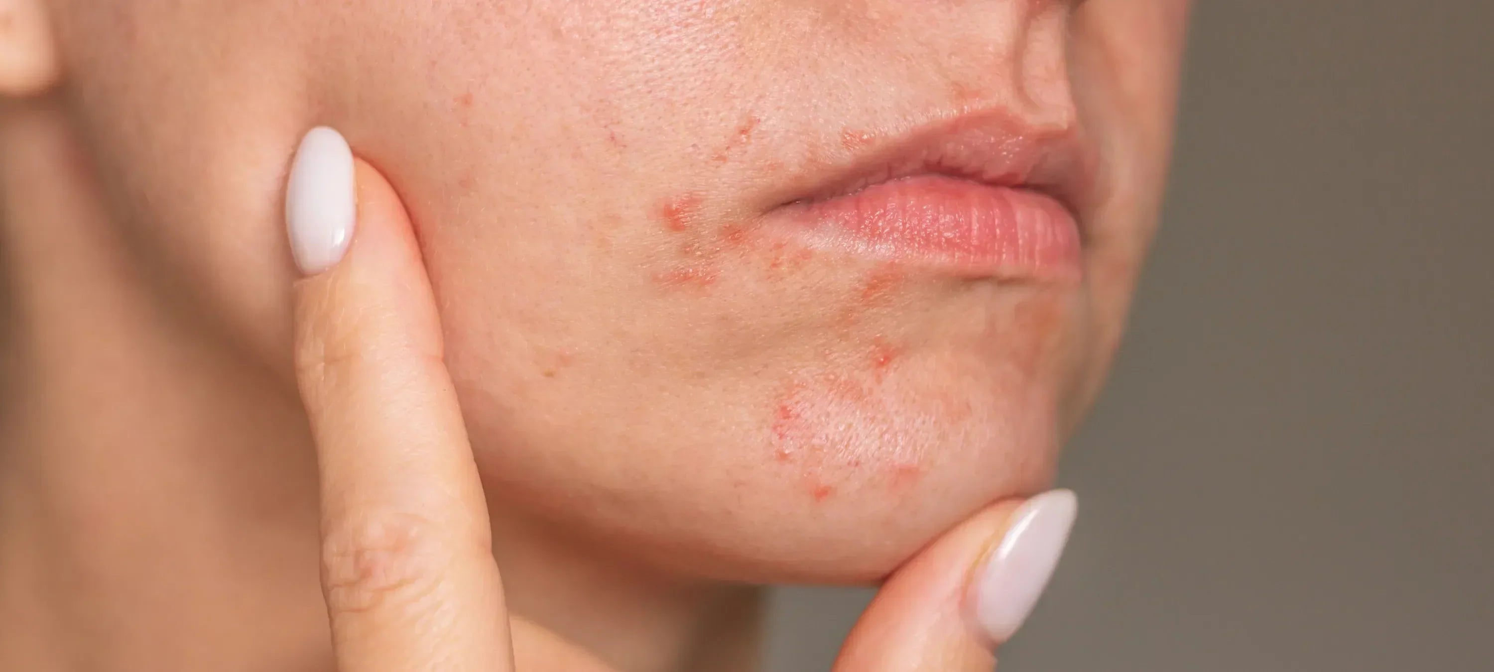 Frau berührt mit Finger gereizte Haut mit roten Pickeln um den Mund