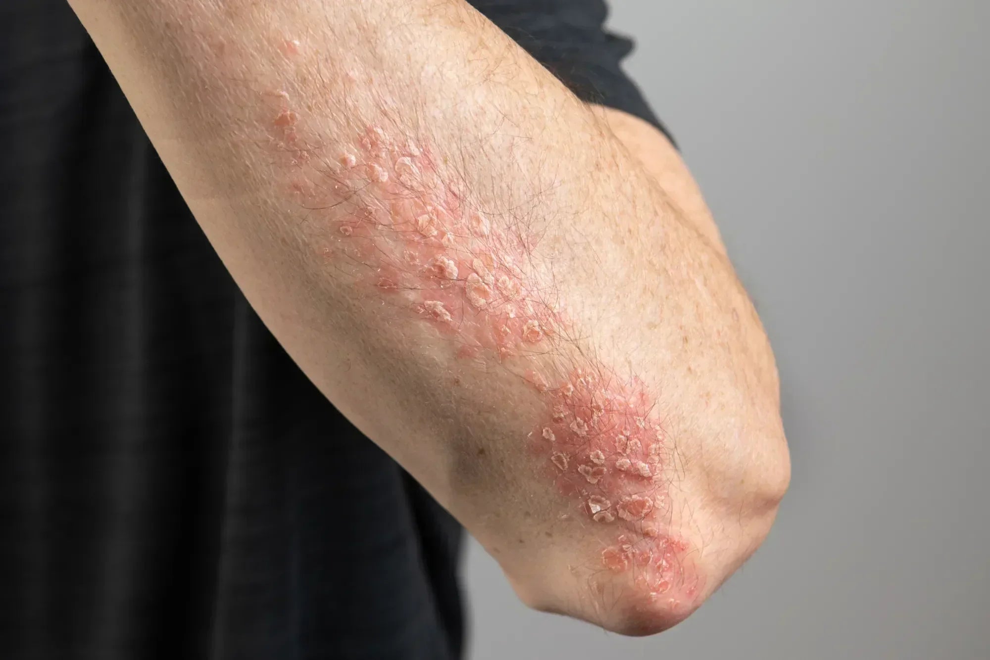 Schuppenflechte: Der große Ratgeber zu Ursachen, Symptomen & moderner Behandlung