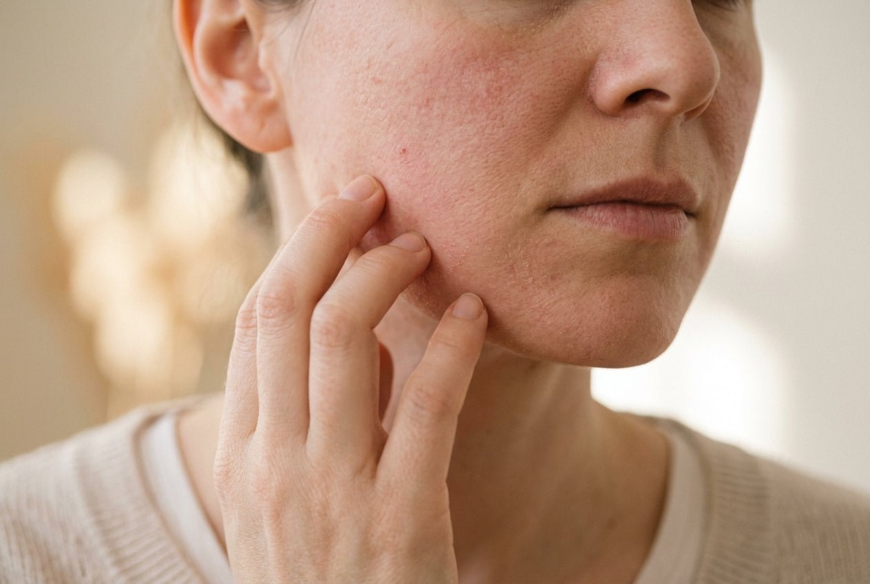 Milde Rötung und trockene Haut an der Wange bei atopischer Dermatitis