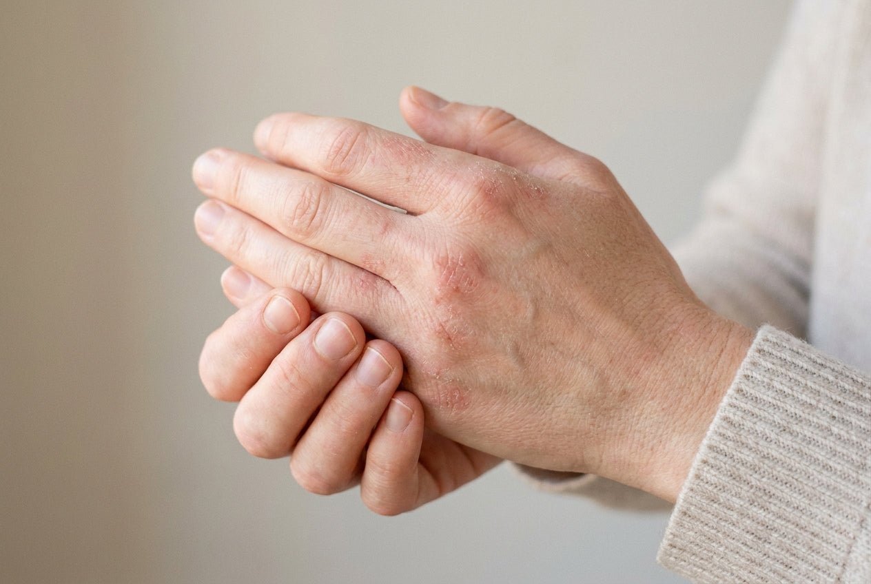 Milde Dermatitis an den Händen mit Rötung und feiner Schuppung
