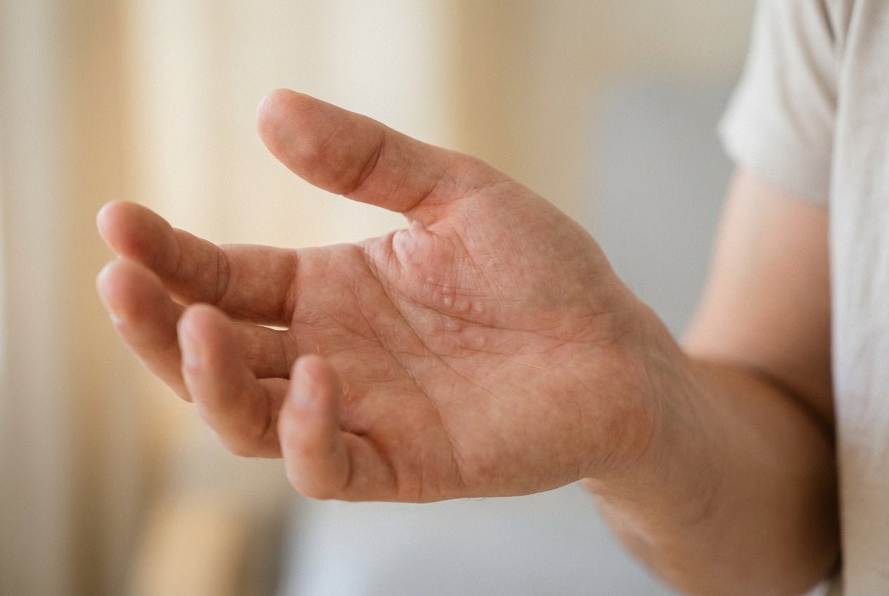 Milde Dyshidrose mit kleinen matten Bläschen an Fingerseiten einer Hand
