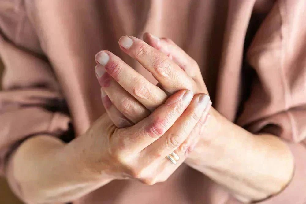 Hände mit sichtbaren Hautveränderungen durch dyshidrotisches Ekzem, Person hält eine Hand mit der anderen