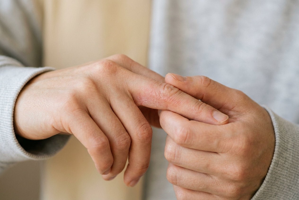 Mildes Fingerekzem mit Rötung und feiner Schuppung an der Fingerseite