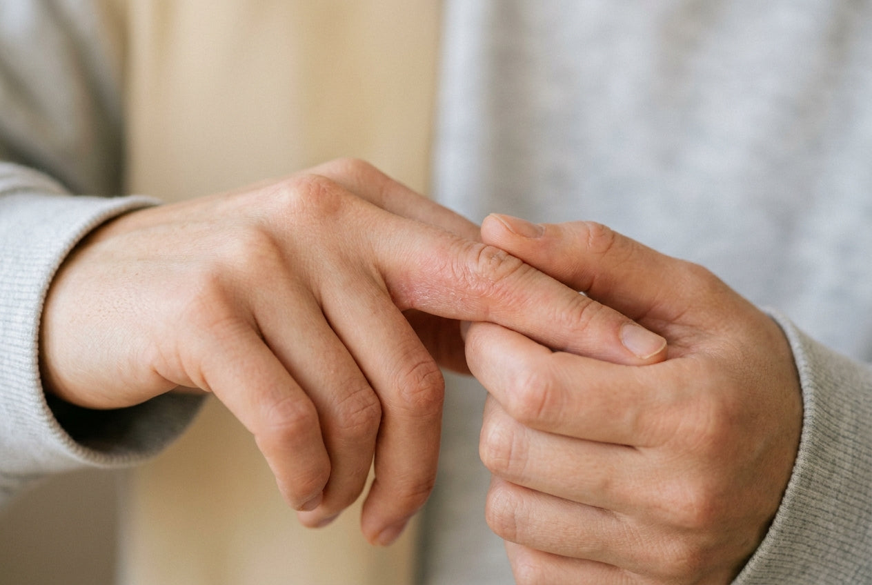 Mildes Fingerekzem mit Rötung und feiner Schuppung an der Fingerseite