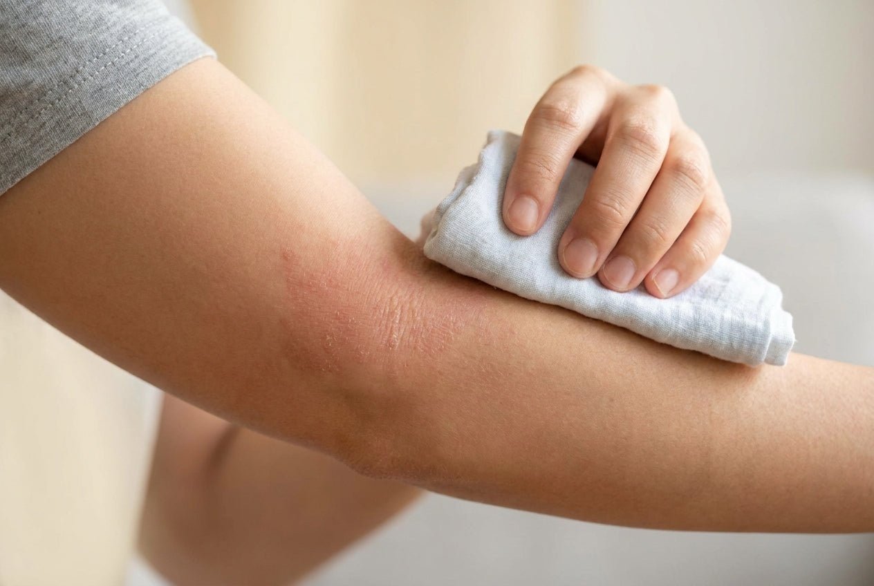 Milder Neurodermitis-Schub in der Armbeuge, Hand kühlt mit feuchtem Tuch