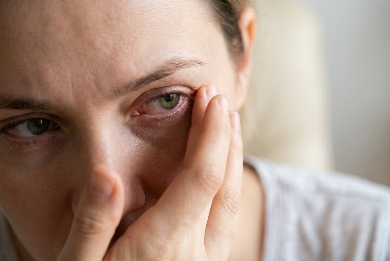 Mild gerötetes, juckendes Auge mit sanfter Berührung am äußeren Augenwinkel