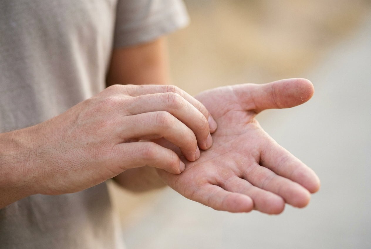 Juckende Handinnenfläche ohne Ausschlag, leichte Trockenheit an den Fingerkuppen