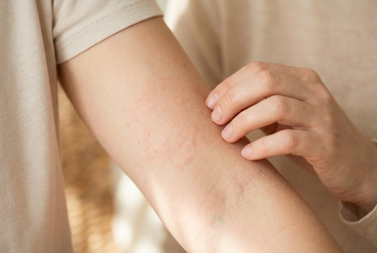 Milder Juckreiz mit leichter Rötung an der Unterarm-Oberseite, Hand berührt Haut