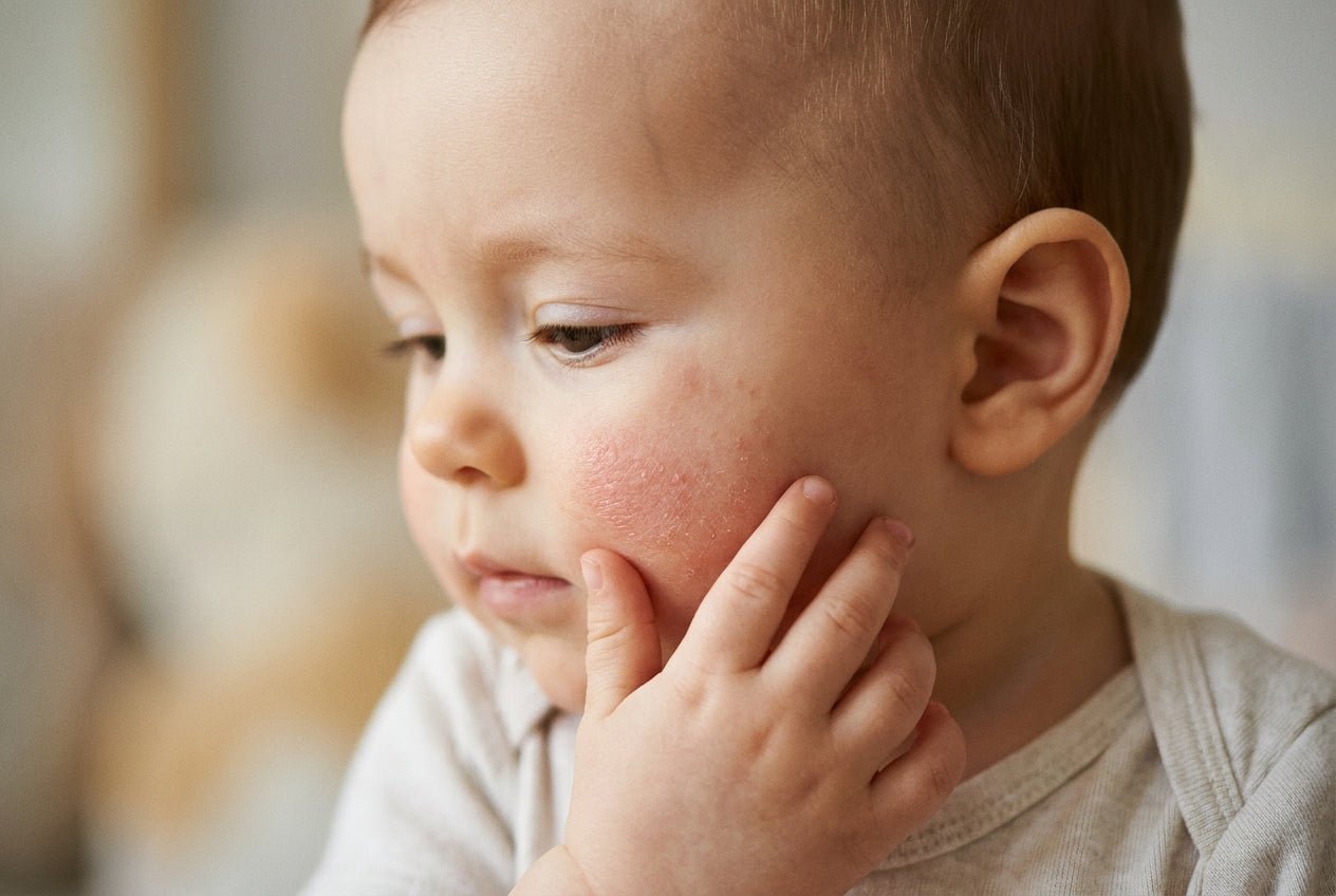 Milde Wangenrötung und trockene Haut bei Baby, Hinweis auf Neurodermitis