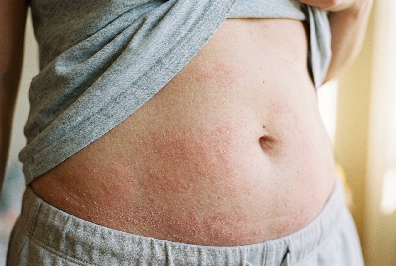 Milde Neurodermitis am Bauch mit trockener Rötung nahe der Bundlinie