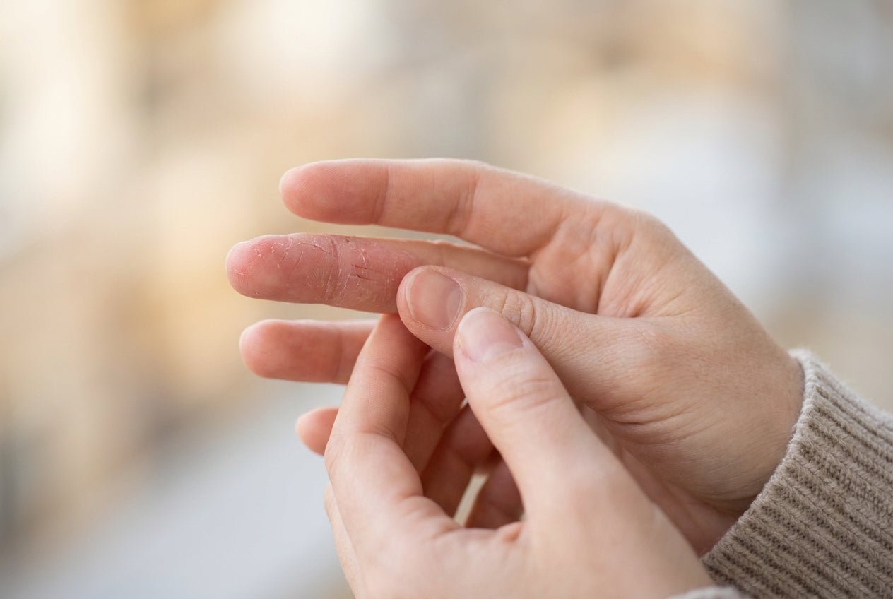 Milde Neurodermitis am Finger mit Rötung und trockener Schuppung an der Fingerkuppe