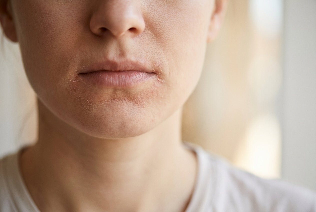 Milde Neurodermitis am Mund mit trockener Rötung am Lippenrand und Kinn