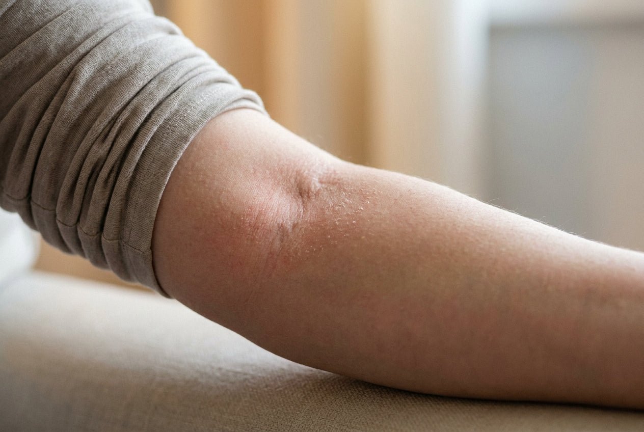 Milde Neurodermitis in der Armbeuge mit Rötung und trockener Schuppung