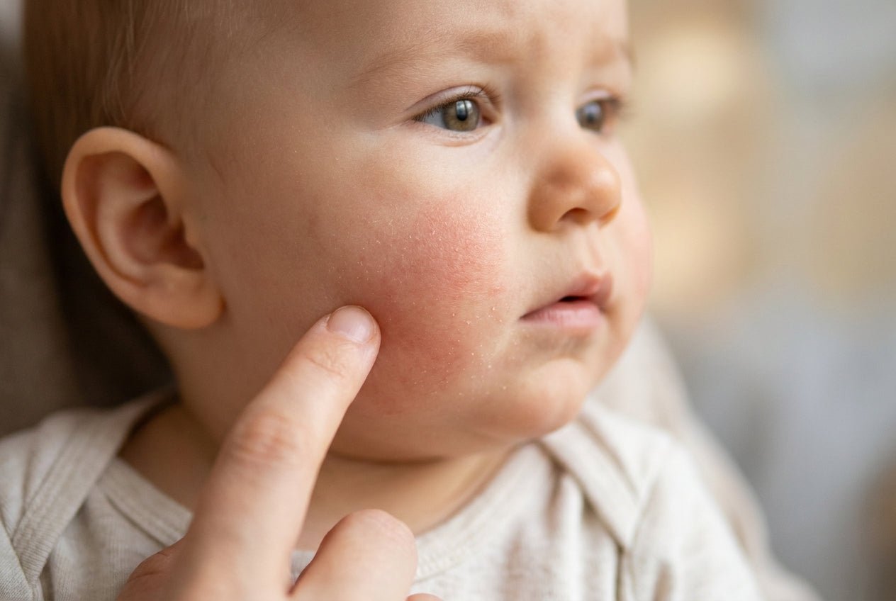 Babywange mit mildem Neurodermitis-Ekzem, Rötung und trockener Schuppung