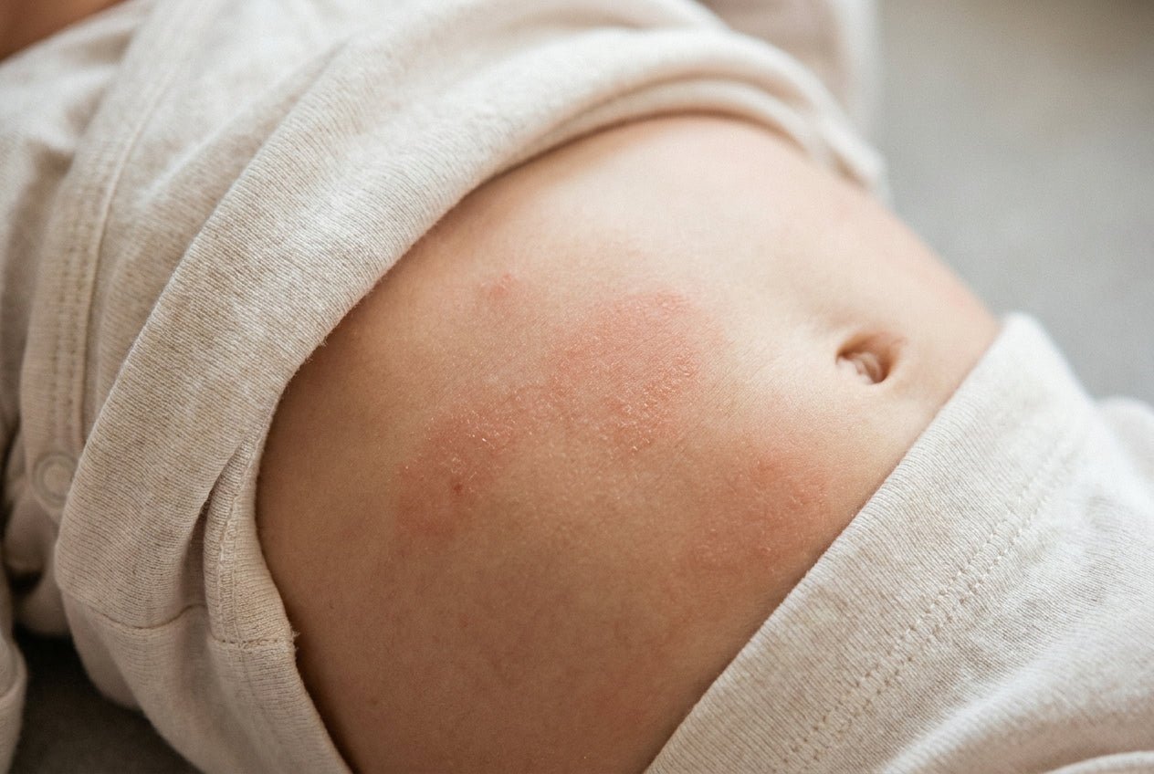 Milde Neurodermitis am Babybauch mit leichter Rötung und trockenen Stellen