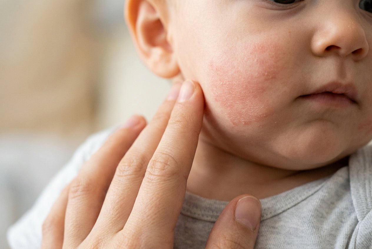 Babywange mit mild gerötetem, trocken-schuppigem Neurodermitis-Ekzem