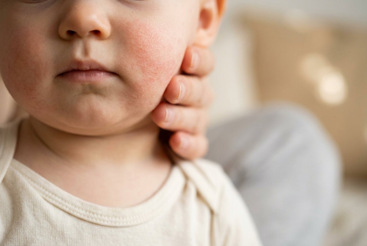 Milde Neurodermitis-Rötung und trockene Haut an Babywange und Mundbereich