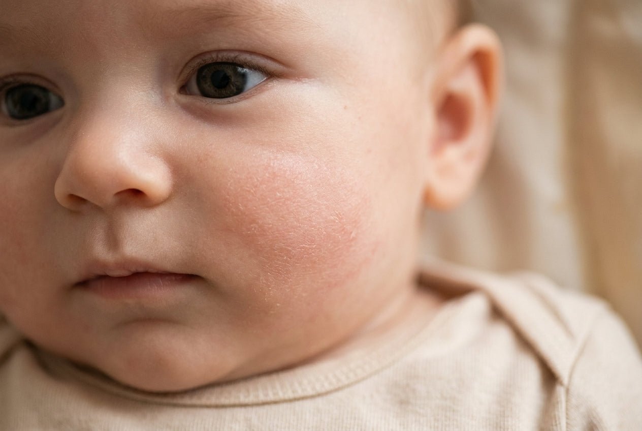 Milde Neurodermitis am Babygesicht mit trockener, leicht geröteter Wange