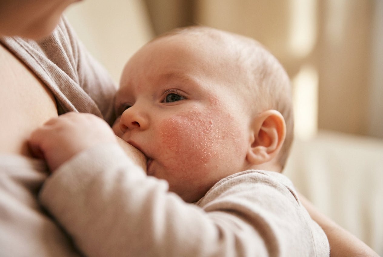 Babywange mit Neurodermitis: trockene Rötung und feine Schuppung