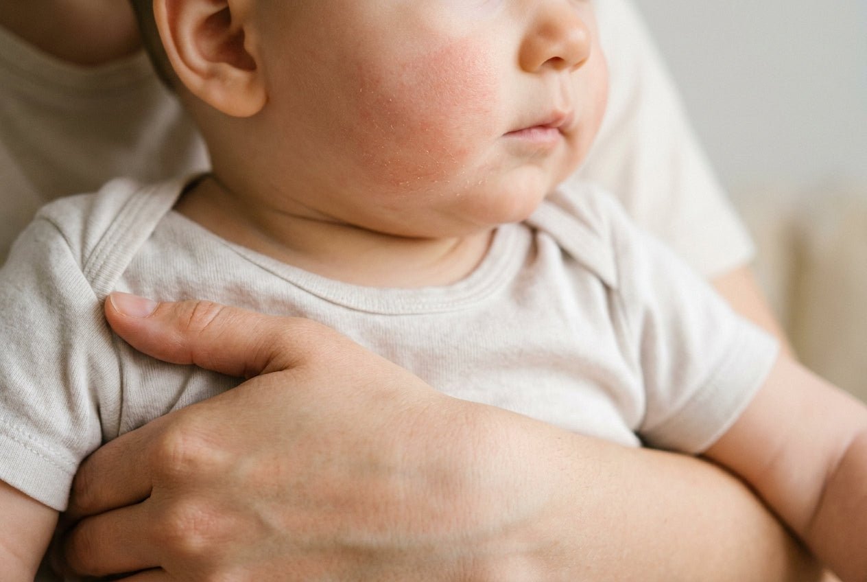 Milde Neurodermitis mit Rötung und trockener Schuppung an der Babywange