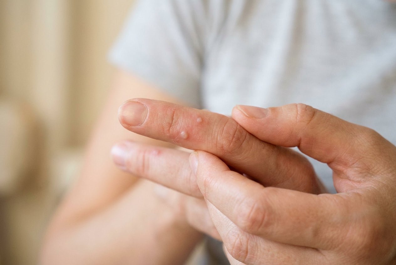 Milde Fingerbläschen mit Rötung und Trockenheit an der Fingerseite einer Hand