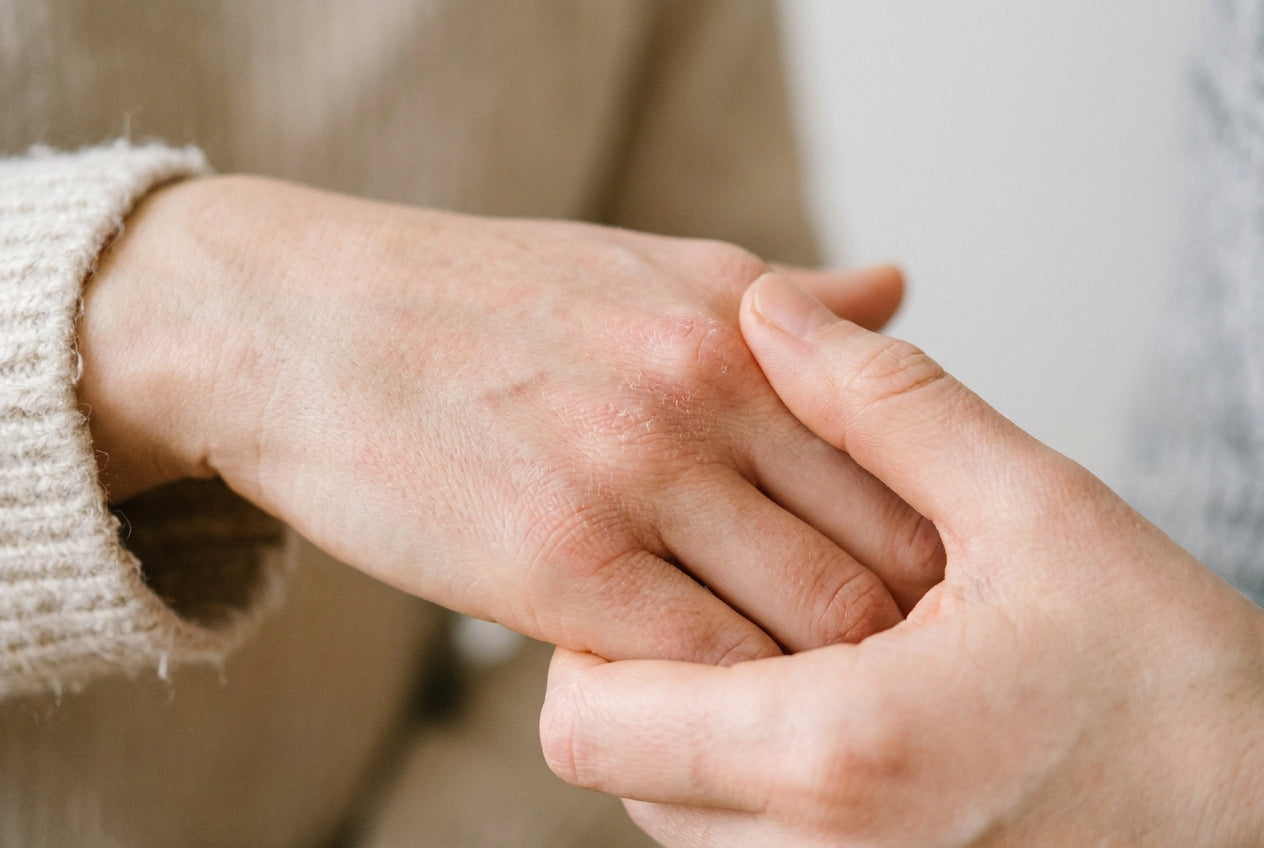 Milde Neurodermitis an den Händen mit Rötung und trockener Schuppung am Handrücken