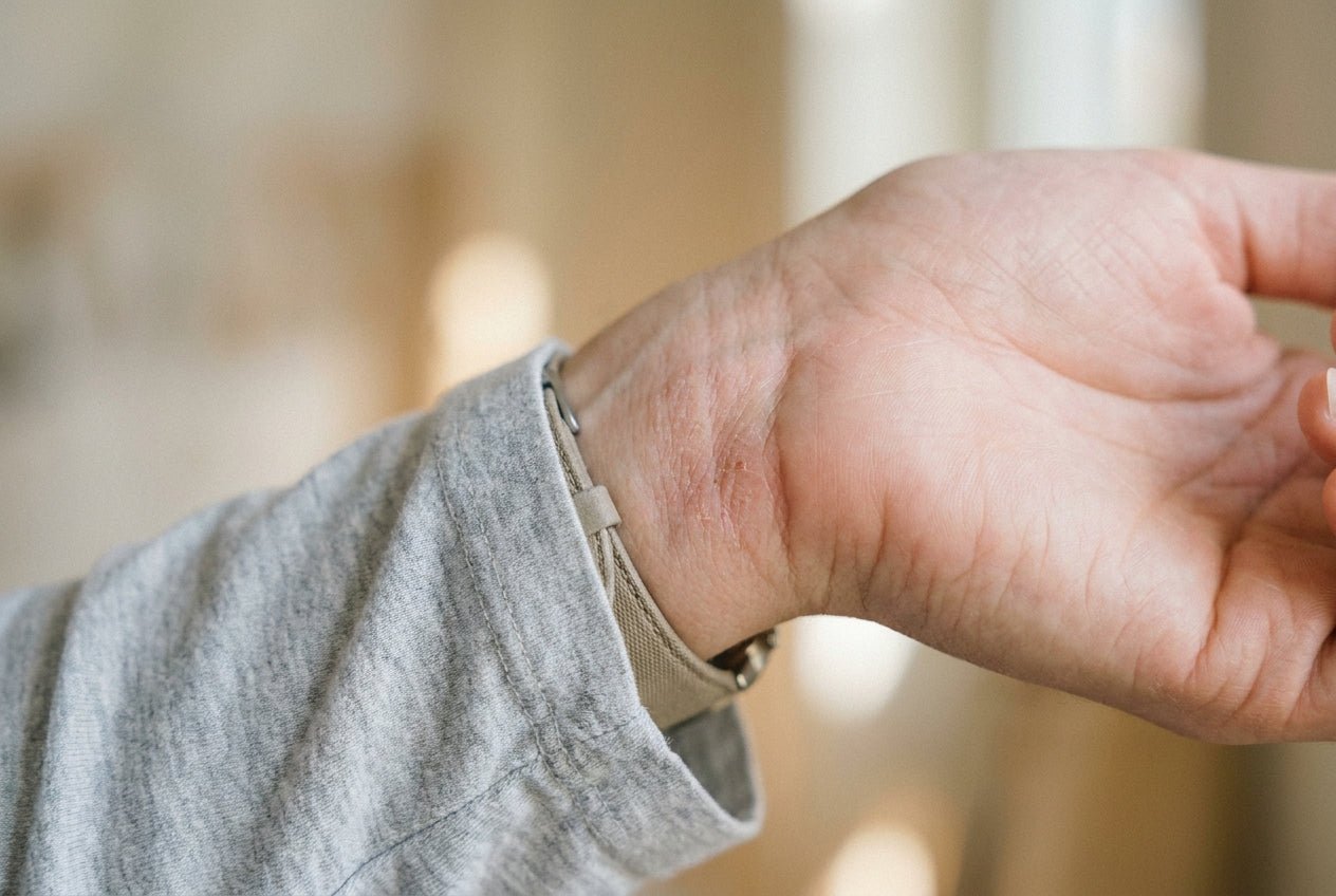 Milde Rötung und trockene Schuppung bei Neurodermitis am Handgelenk in Beugefalte