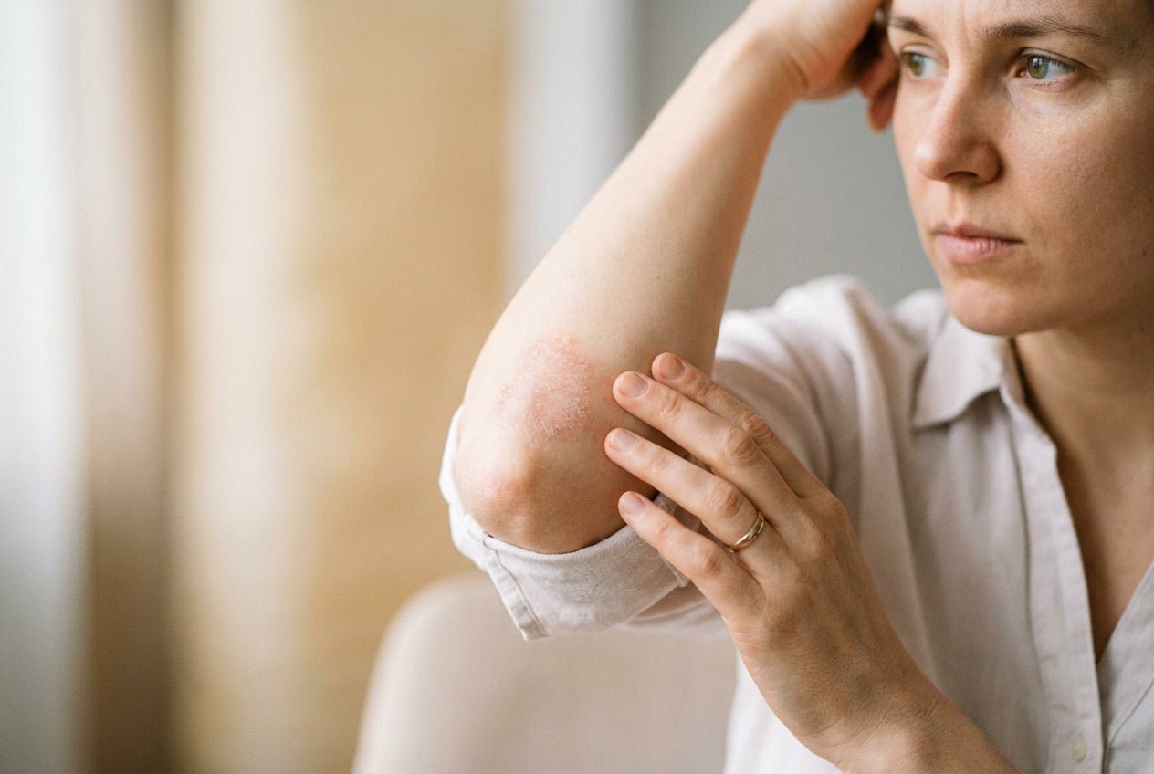 Mild gerötete, trockene Ekzemstelle in der Armbeuge bei Neurodermitis-Juckreiz
