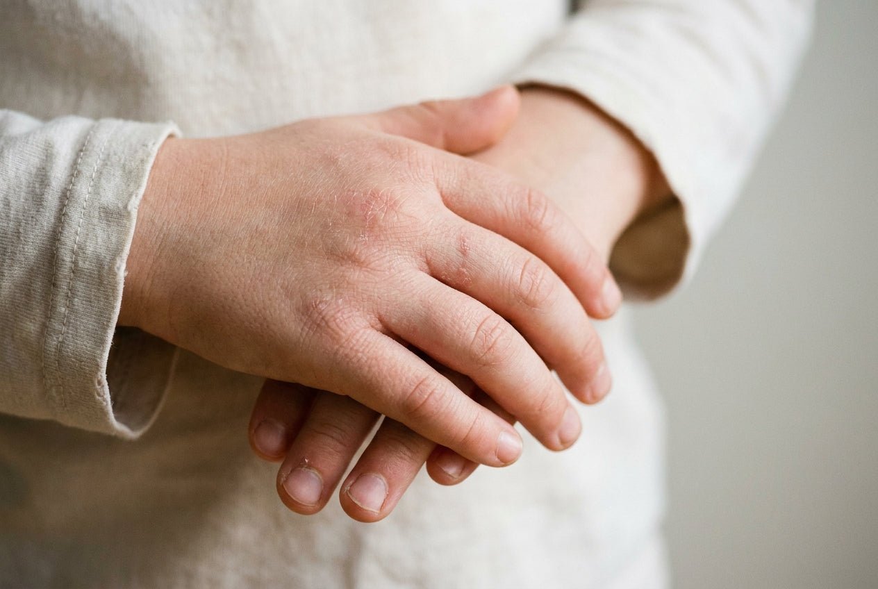 Milde Neurodermitis an Kinderhänden mit trockenen, geröteten Knöcheln