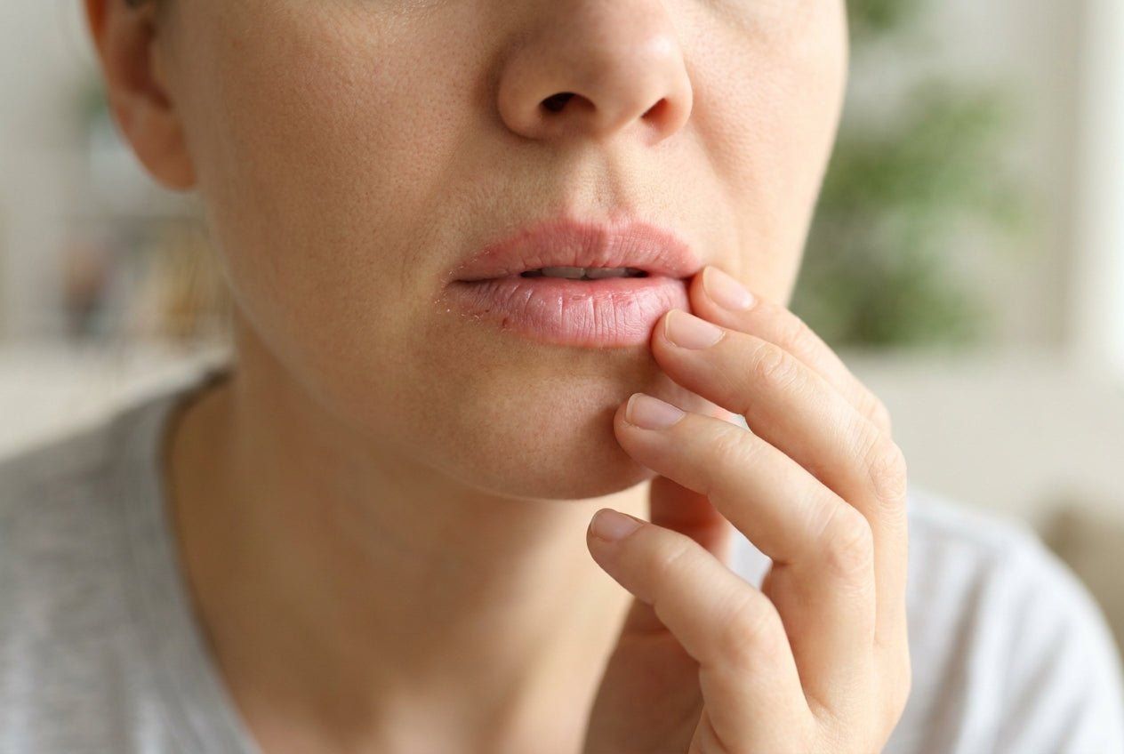 Milde Roetung und Schuppung am Lippenrand bei Neurodermitis